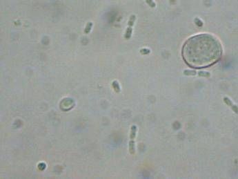 Batterio mangiacarne uccide 4 persone, Bassetti: “Colpa del clima”